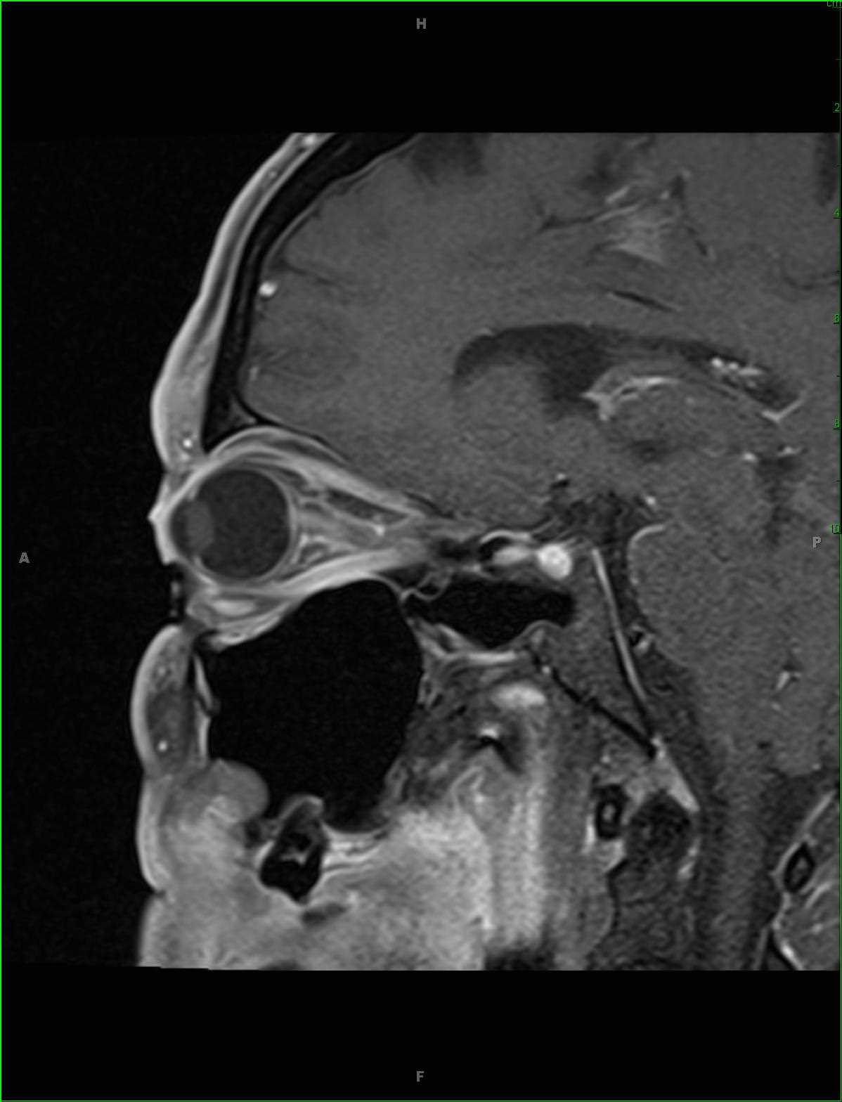 Optic Neuritis - CTisus CT Scan