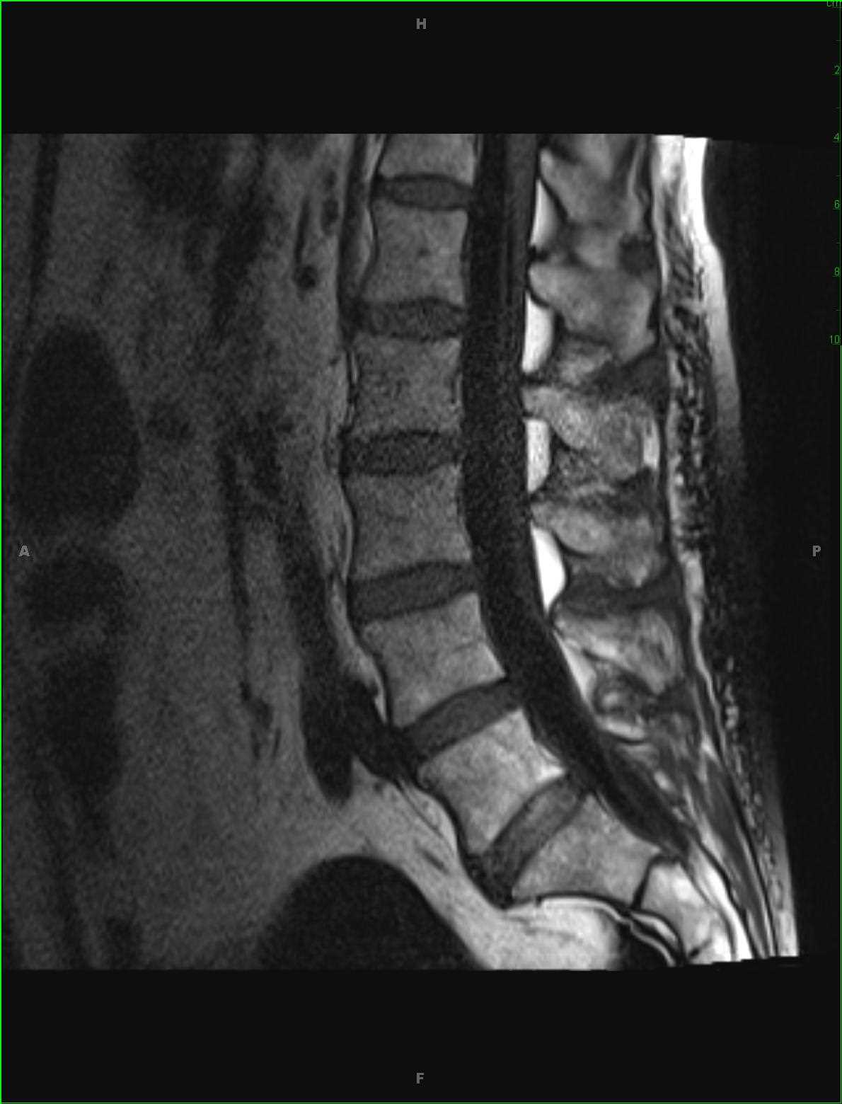 Infectious Arachnoiditis - CTisus CT Scan