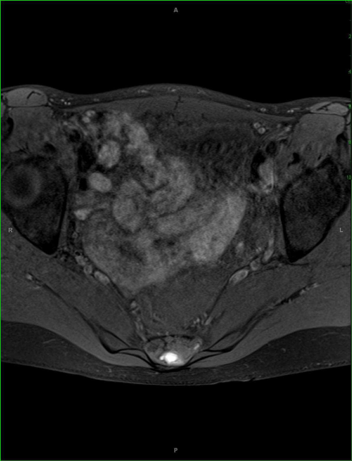 Chordoma - CTisus CT Scan