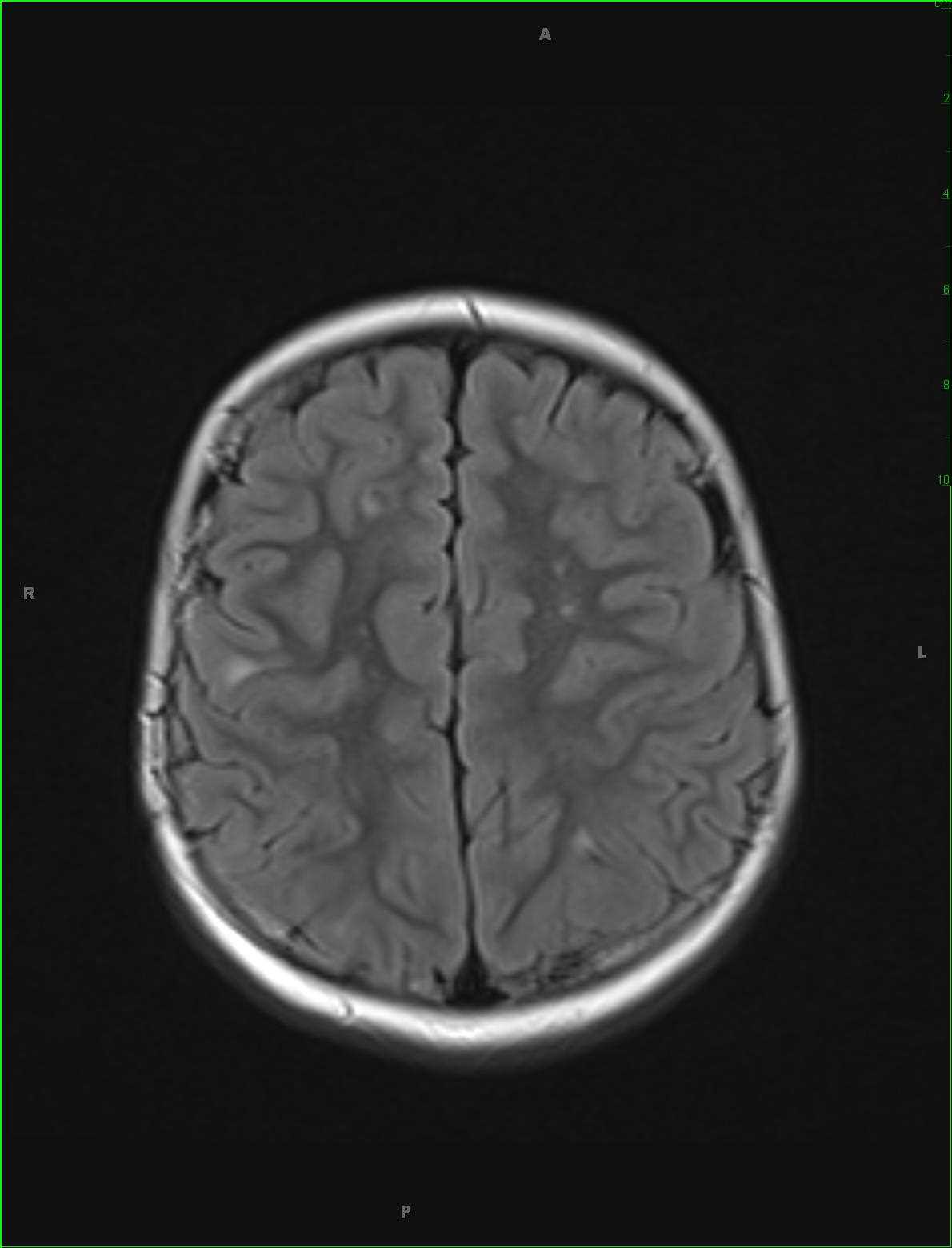 Tuberous Sclerosis with Subependymal Giant Cell Astrocytoma - CTisus CT Scan