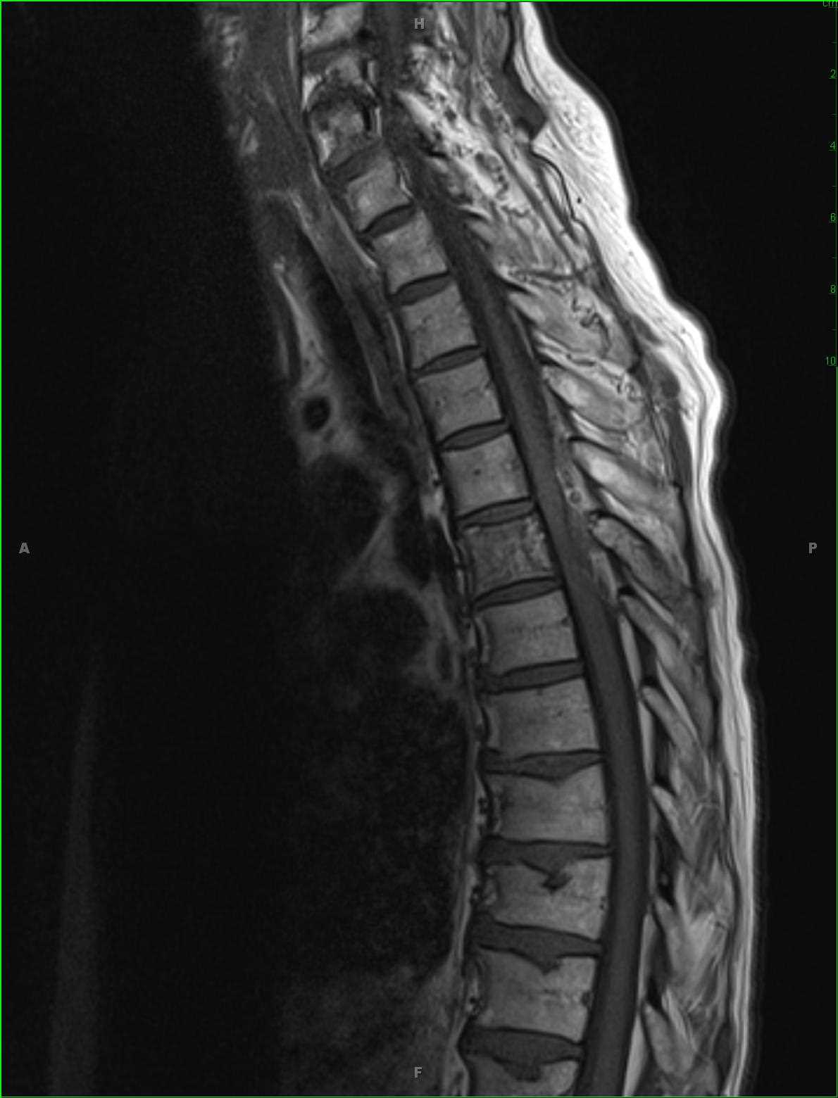 Aggressive Hemangioma - CTisus CT Scan