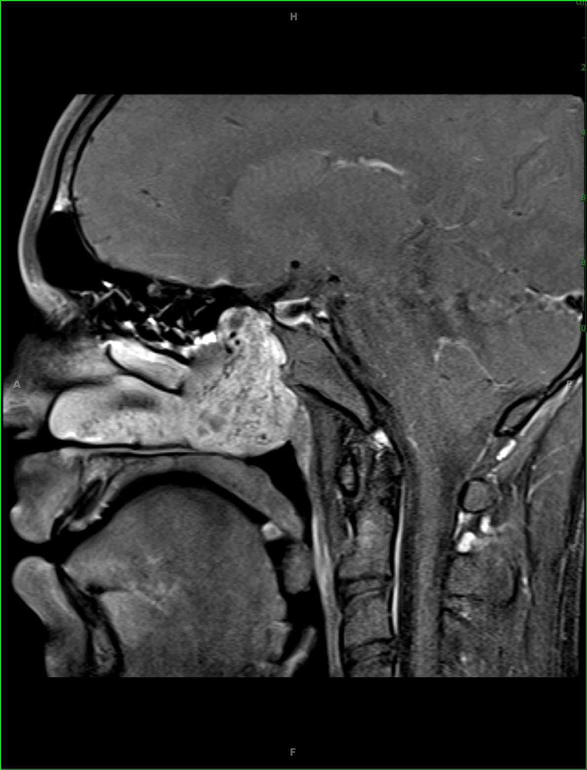 Juvenile Angiofibroma - CTisus CT Scan