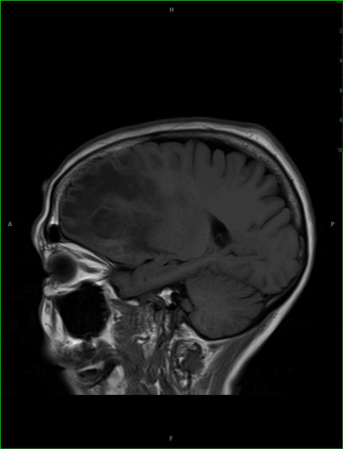 Grade 3 Anaplastic Astrocytoma - CTisus CT Scan