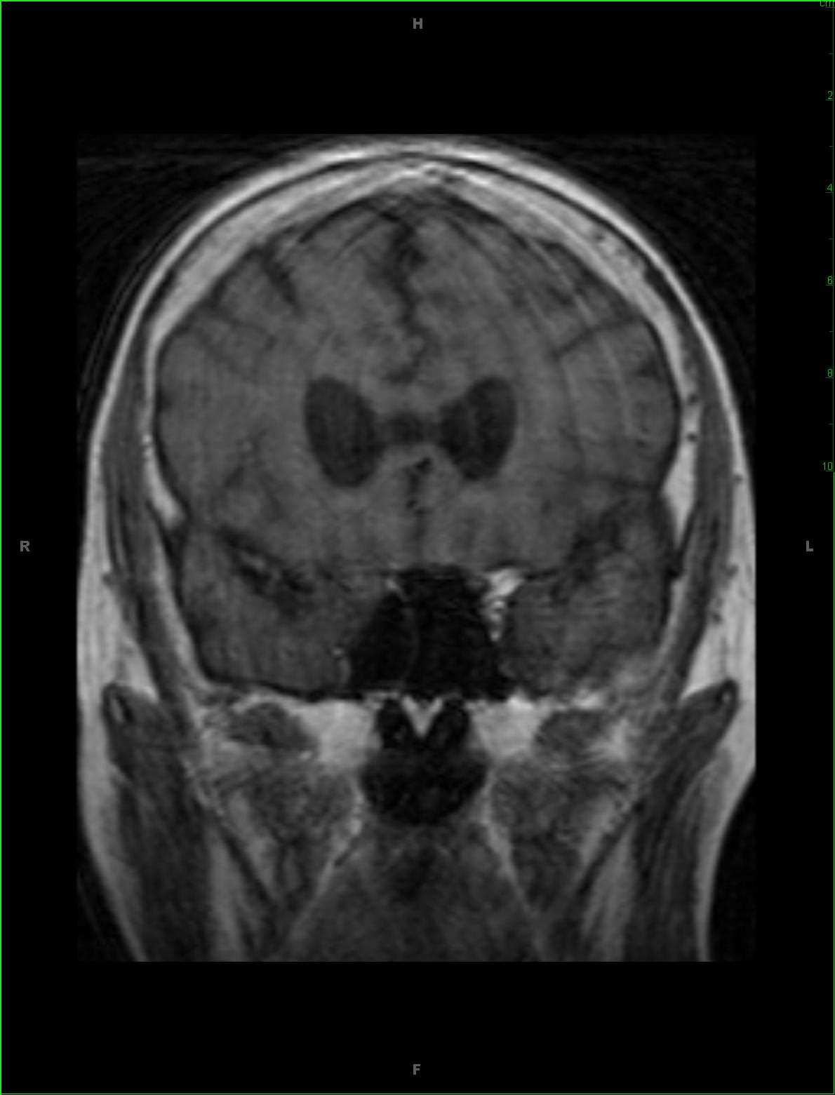 Solitary Fibrous Tumor of the Right Orbit - CTisus CT Scan