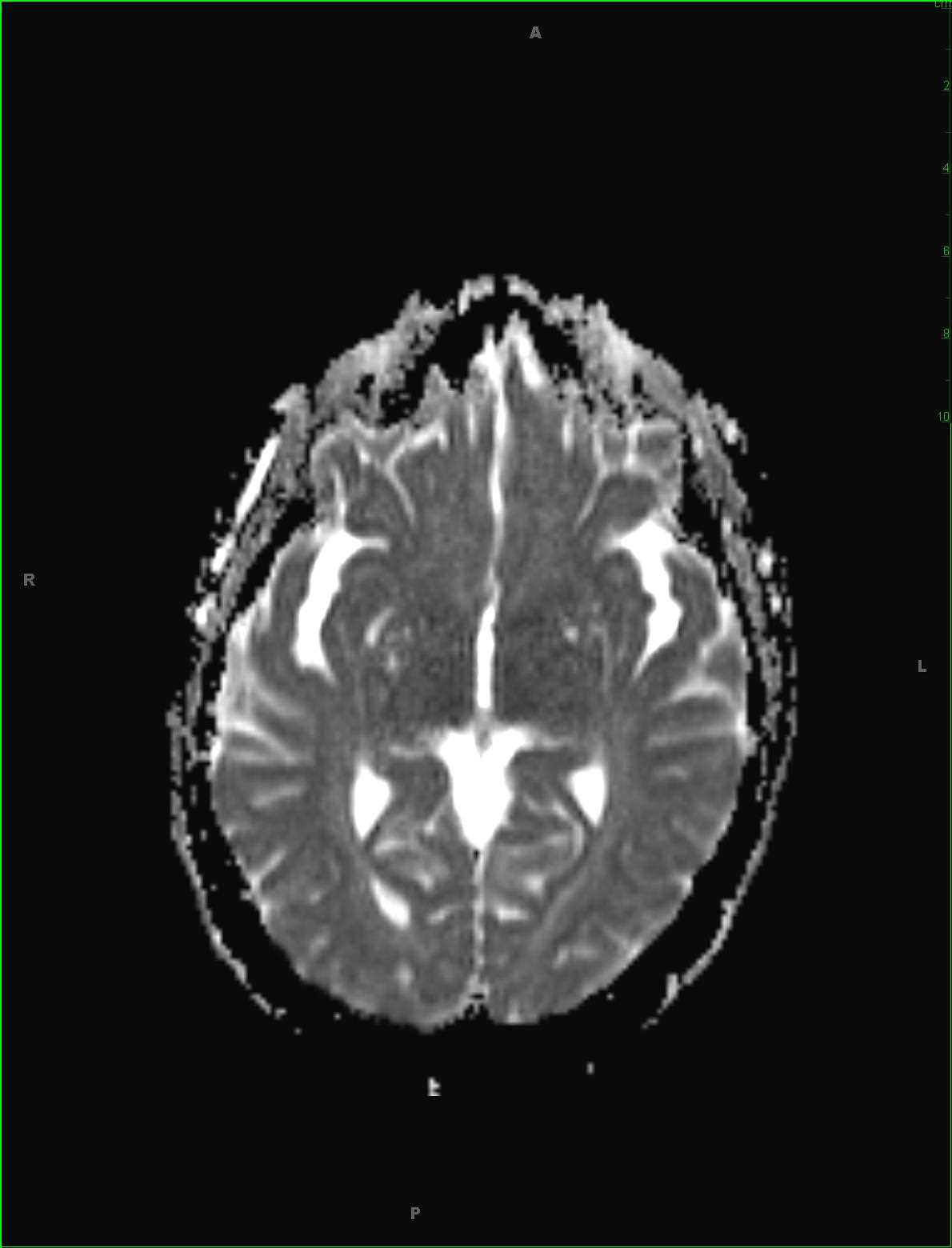 Hepatic Encephalopathy, Secondary to Acetaminophen Overdose - CTisus CT Scan