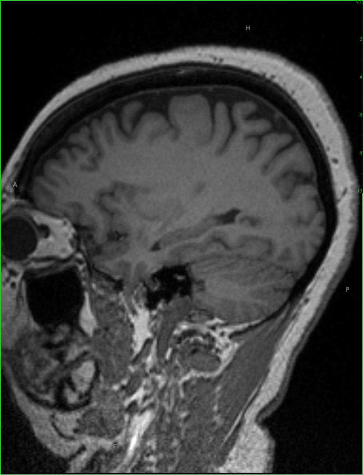 Inferior Right Temporal Encephalocele - CTisus CT Scan