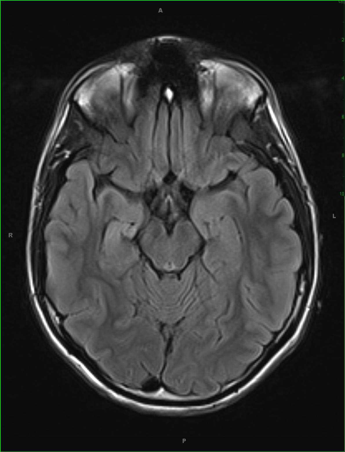 Mesial Temporal Sclerosis, Right - CTisus CT Scan