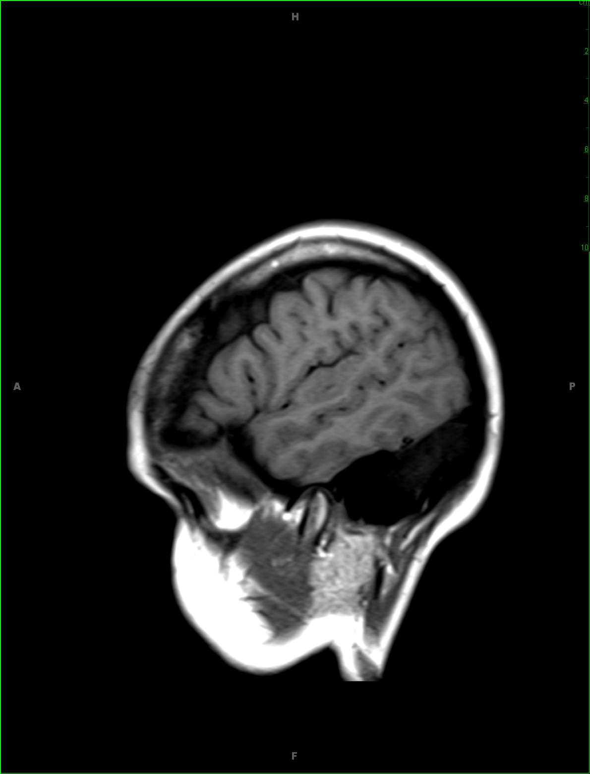 Cortical Dysplasia - CTisus CT Scan