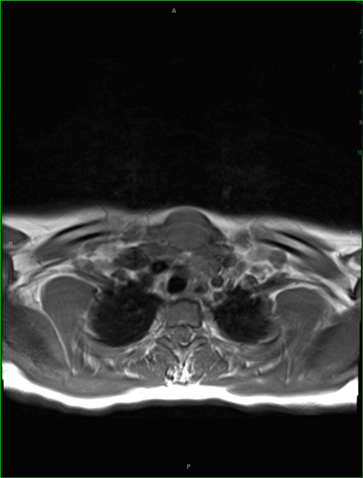 Cortical Dysplasia - CTisus CT Scan