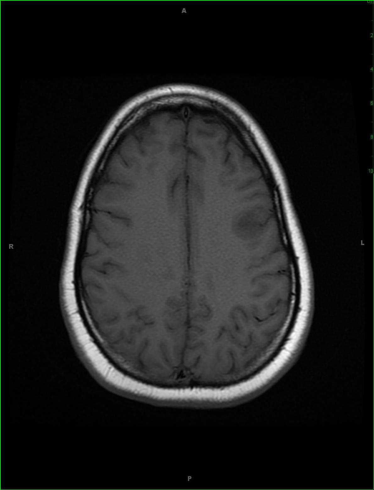 Granulomatous Inflammation, IgG4 Disease - CTisus CT Scan