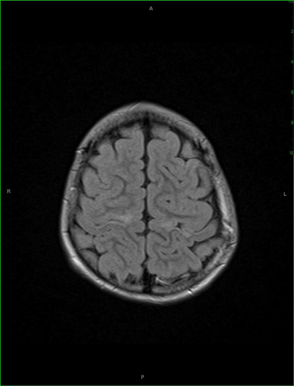 Prior Hypoxic Ischemic Insult with Wallerian Degeneration - CTisus CT Scan