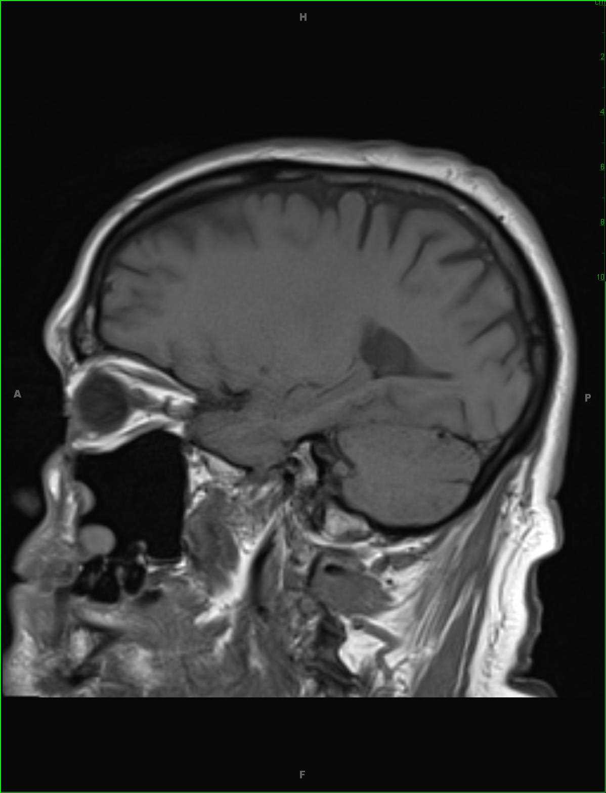 Optic Neuritis - CTisus CT Scan