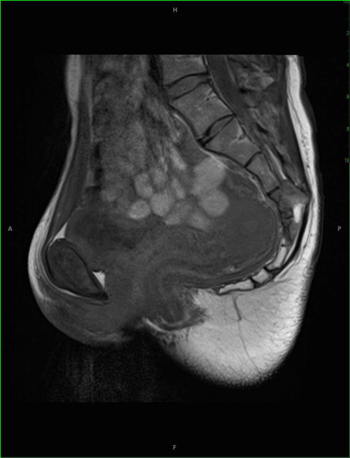 Chordoma - CTisus CT Scan