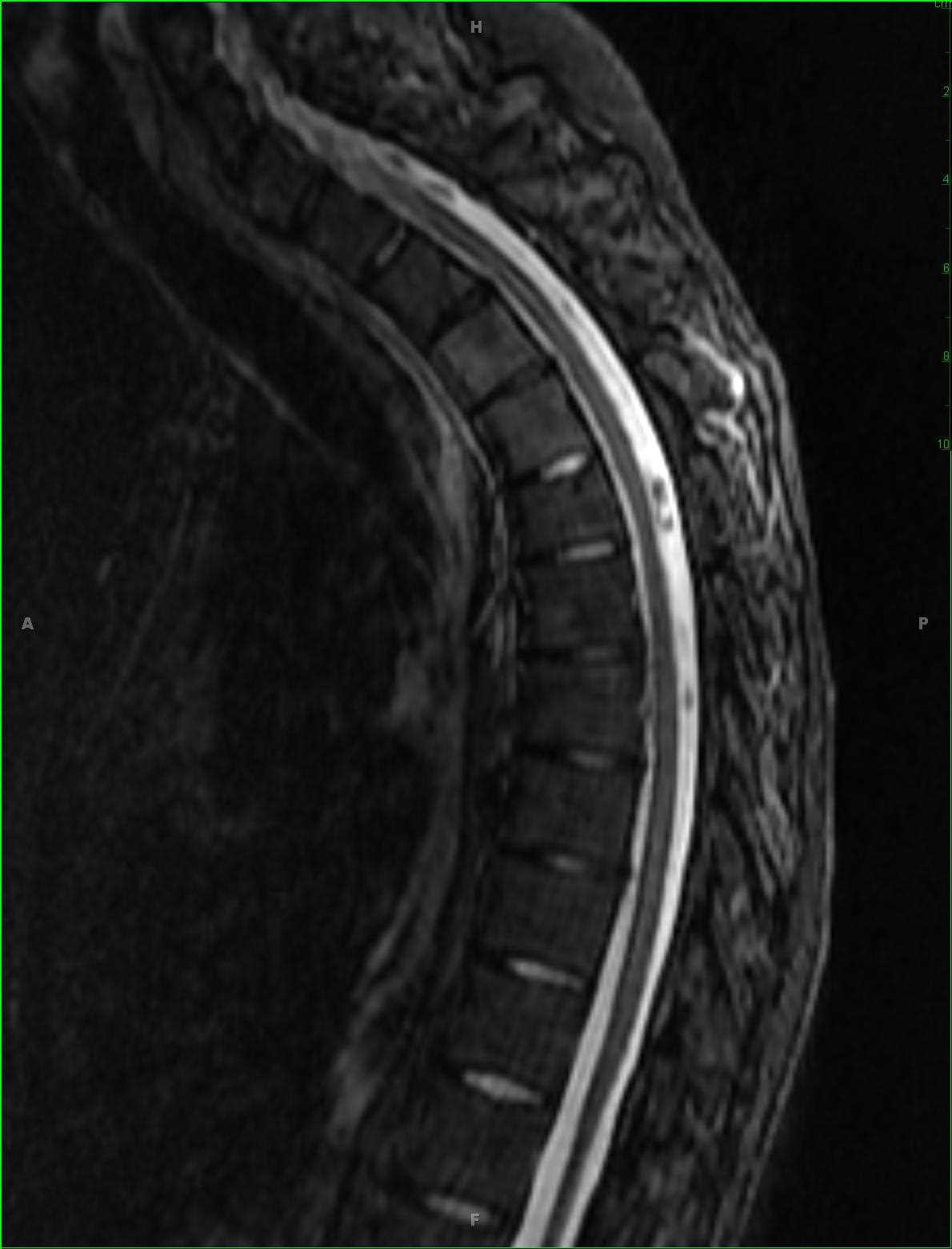 Metastatic Pineoblastoma, Sugarcoating - CTisus CT Scan