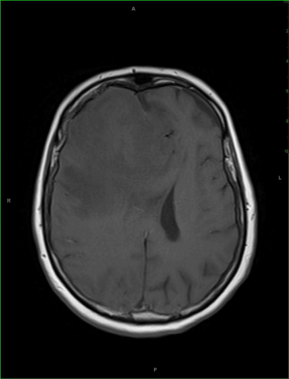 Primary CNS Lymphoma - CTisus CT Scan