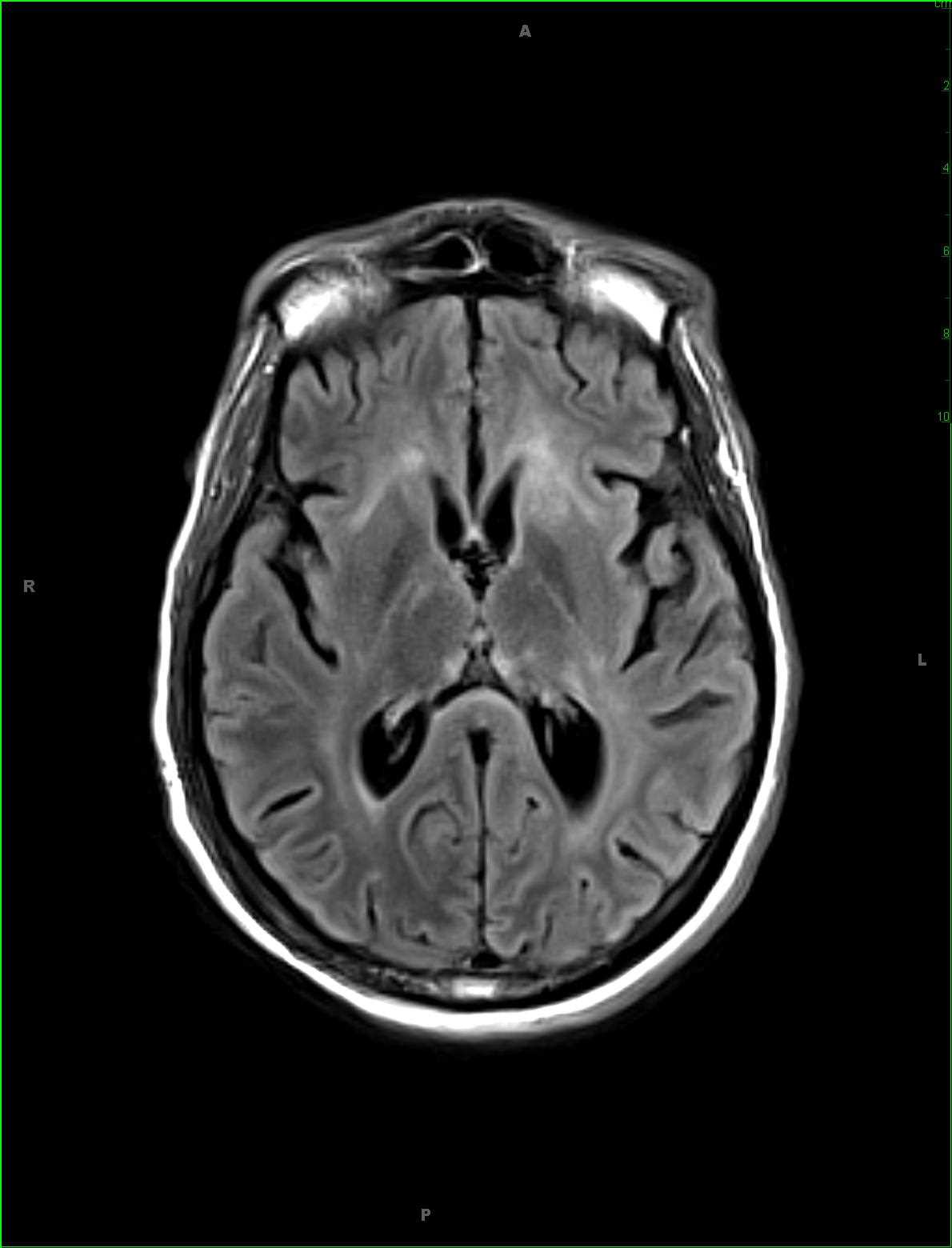 Cryptococcal Meningitis - CTisus CT Scan