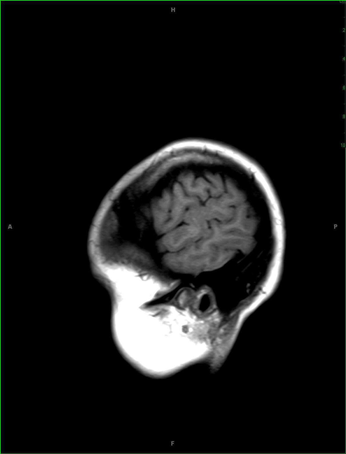 Cortical Dysplasia - CTisus CT Scan