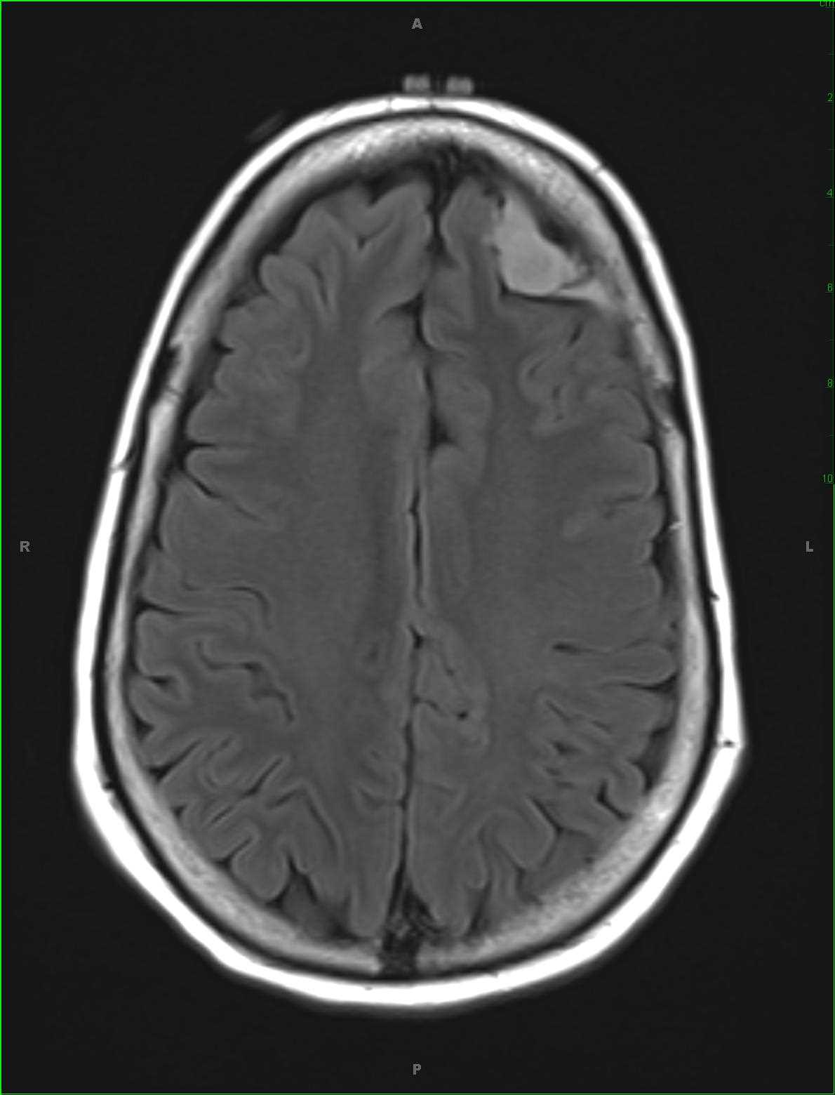 Meningioma with Myxoid Features - CTisus CT Scan