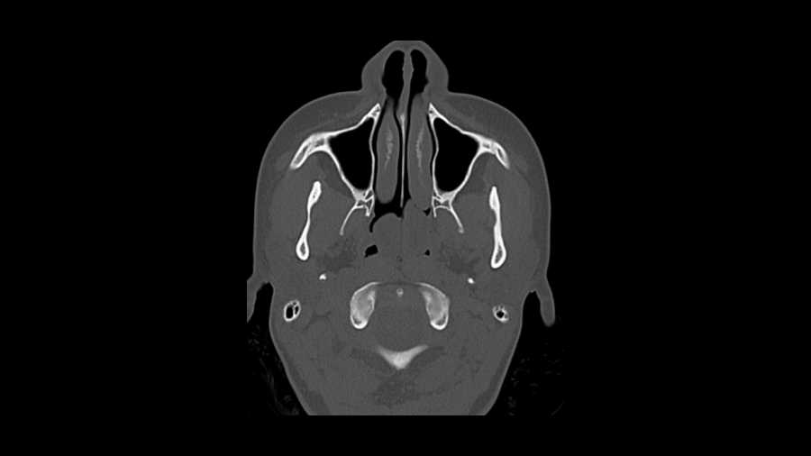 Nasal Polyposis - Neuro MR Case Studies - CTisus CT Scanning