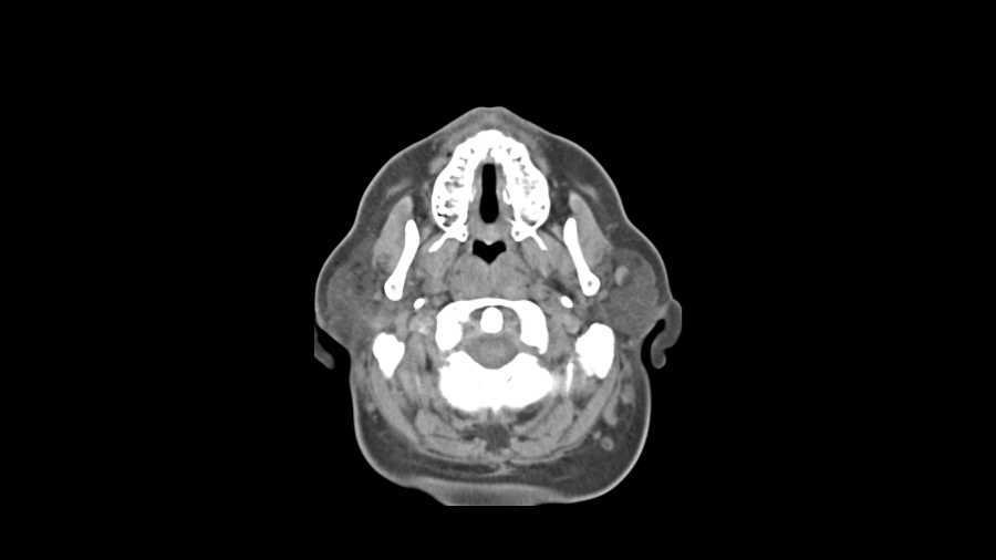 Angiomyolipoma (AML) - CTisus CT Scan