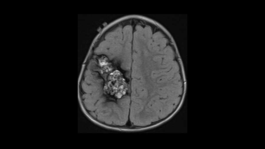 Cavernoma - CTisus CT Scan