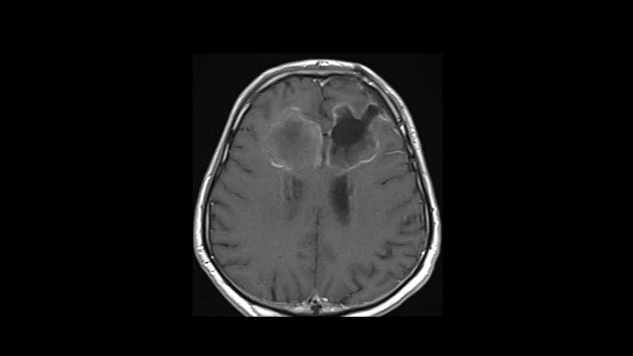 Glioblastoma - CTisus CT Scan