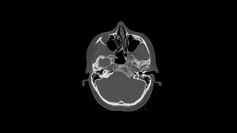 Fibrous Dysplasia Clivus - CTisus CT Scan