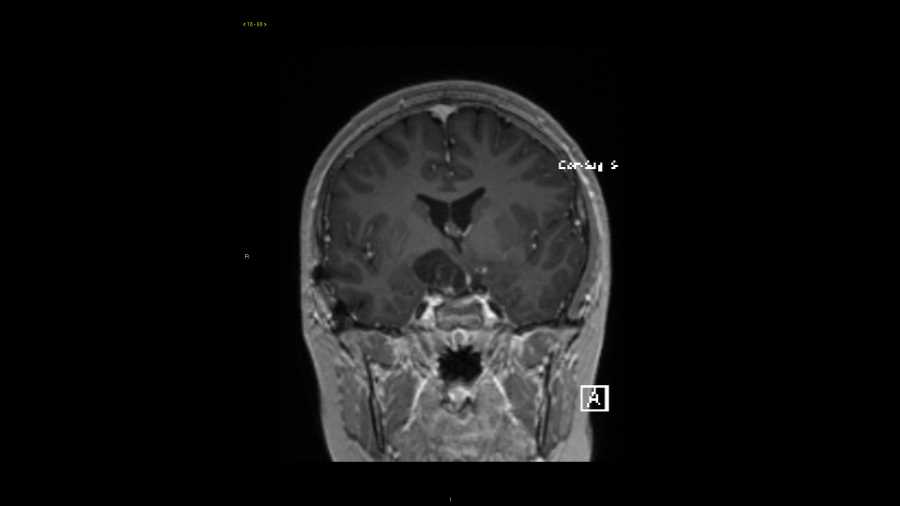 Optic nerve glioma - Neuro MR Case Studies - CTisus CT Scanning