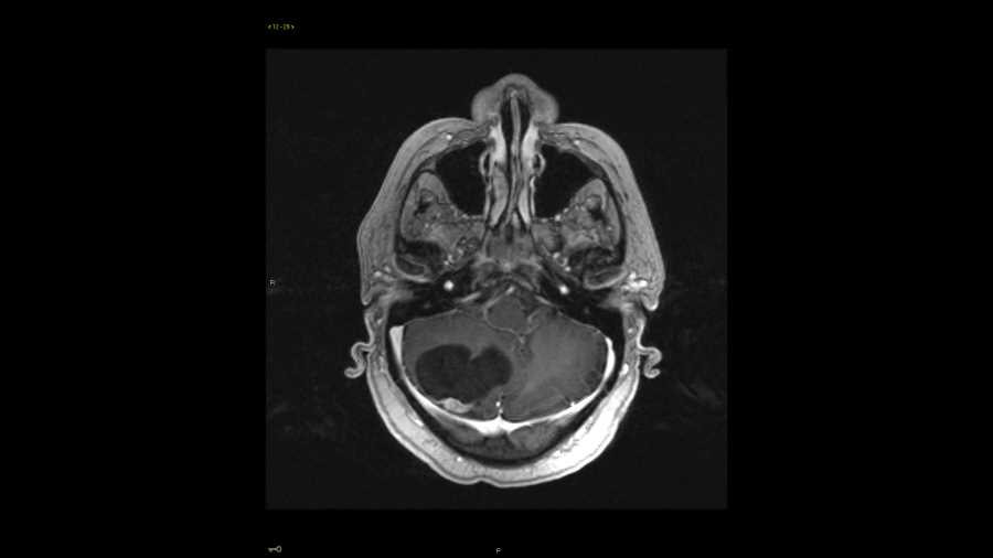 Hemangioblastoma - CTisus CT Scan