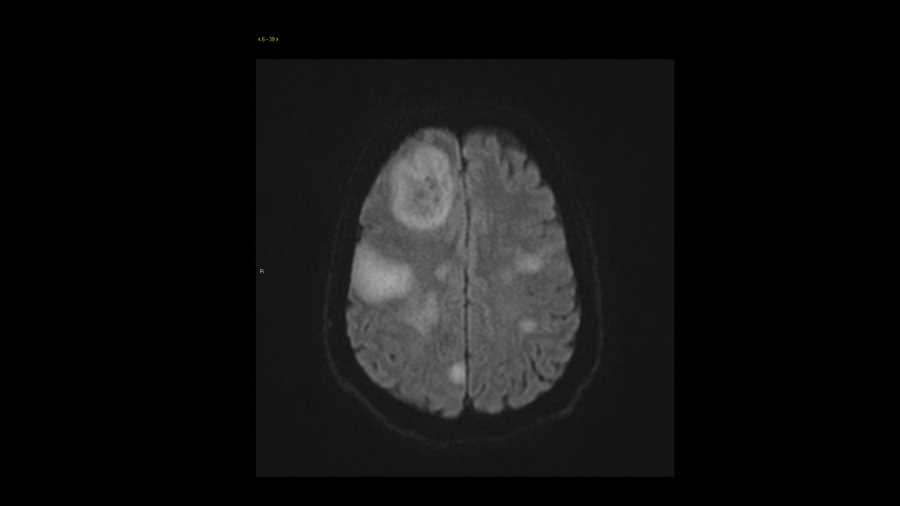 Lymphoma - CTisus CT Scan