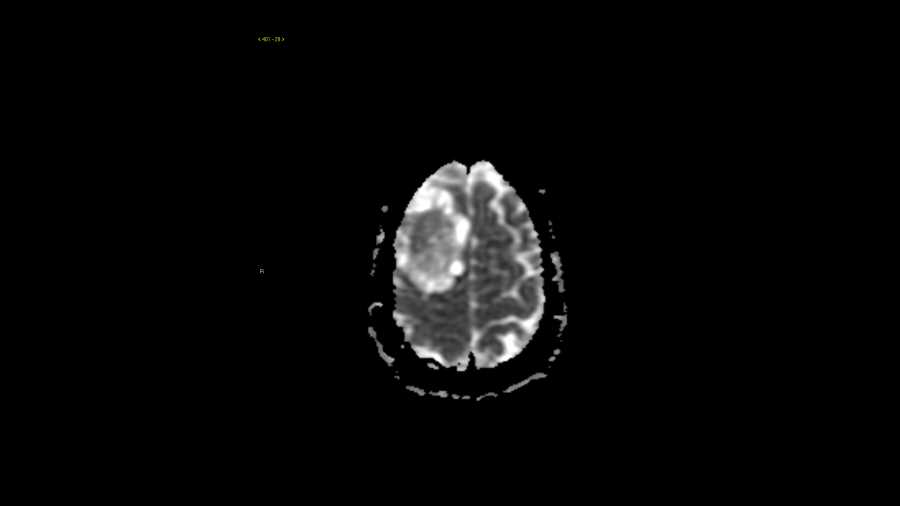 Meningioma - CTisus CT Scan