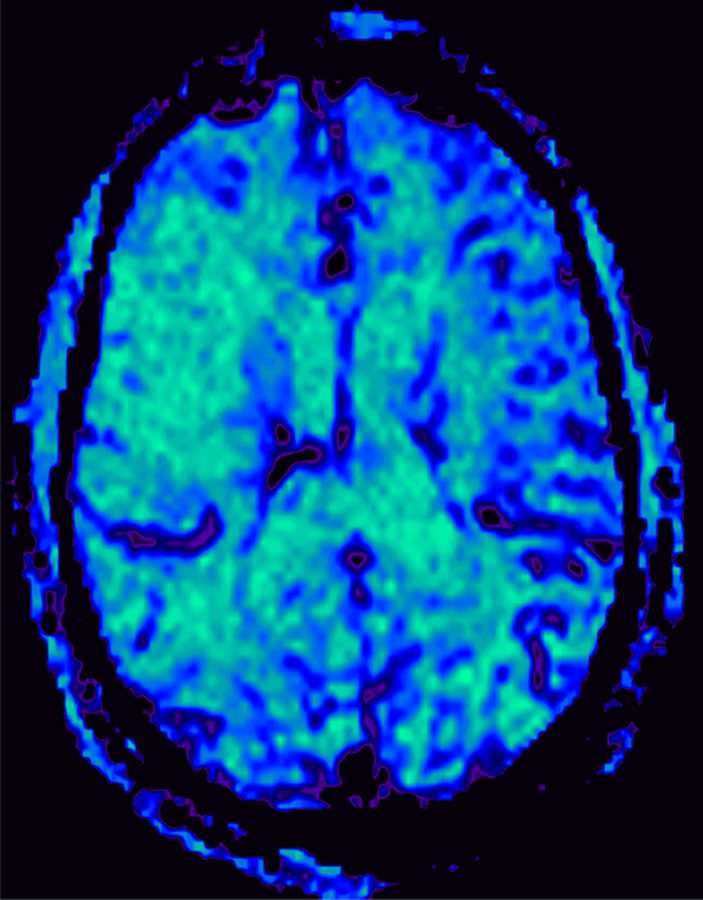 Acute Right MCA Infarct - Neuro MR Case Studies - CTisus CT Scanning