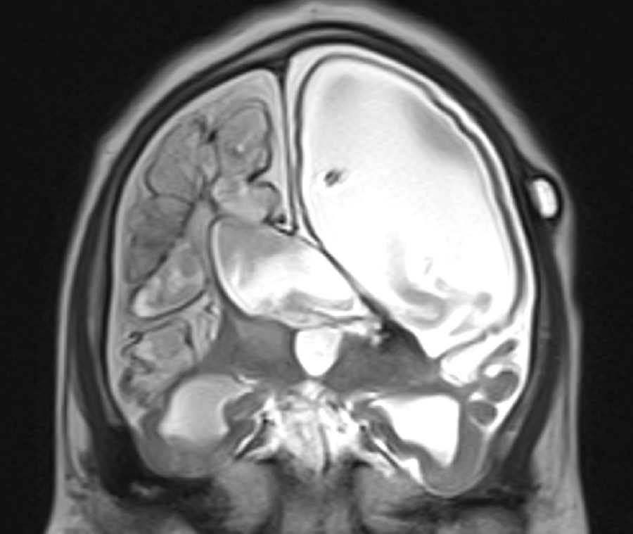 Periventricular Leukomalacia - CTisus CT Scan