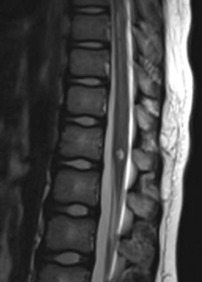 Neurofibromatosis Type 2 - CTisus CT Scan