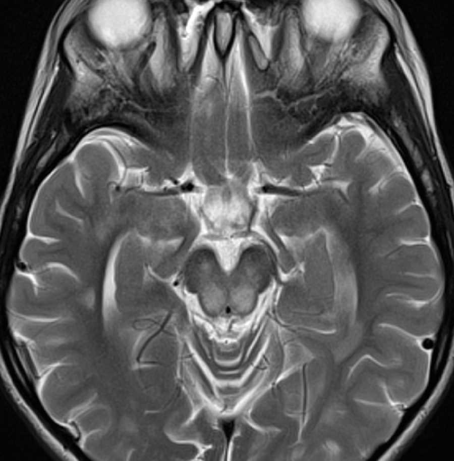 Mitochondrial Deletion - CTisus CT Scan