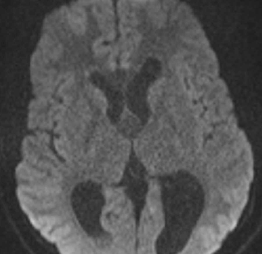 Colloid Cyst - CTisus CT Scan