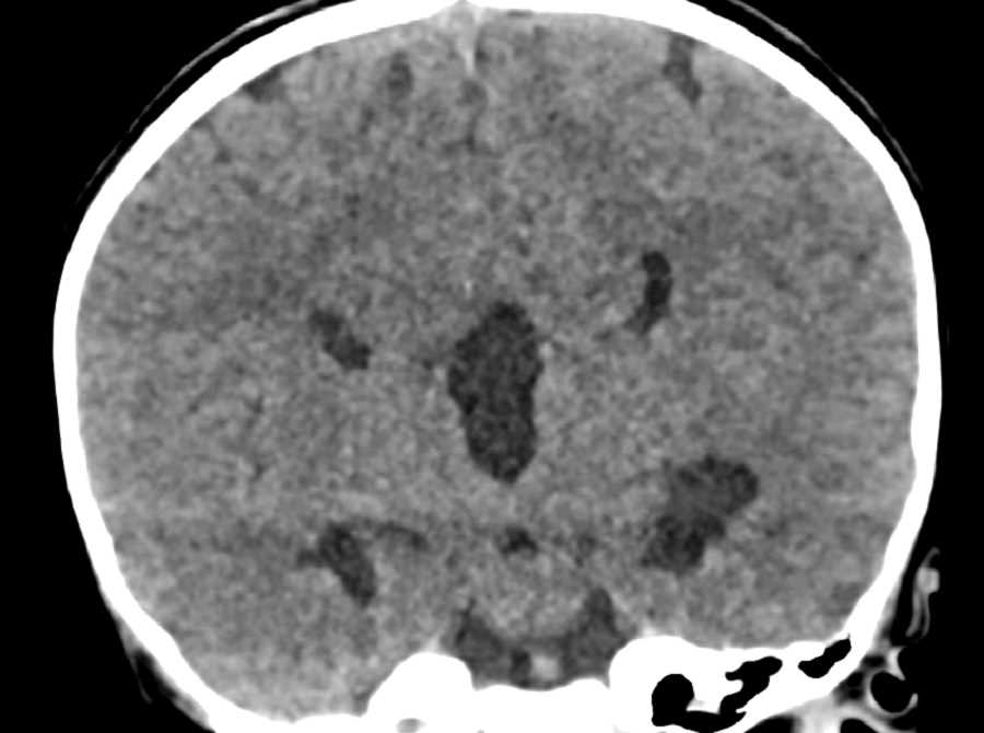 Heterotopic Gray Matter and Agenesis of the Corpus Callosum - CTisus CT Scan