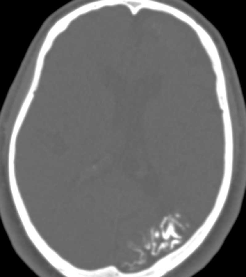 Sturge-Weber Syndrome - CTisus CT Scan