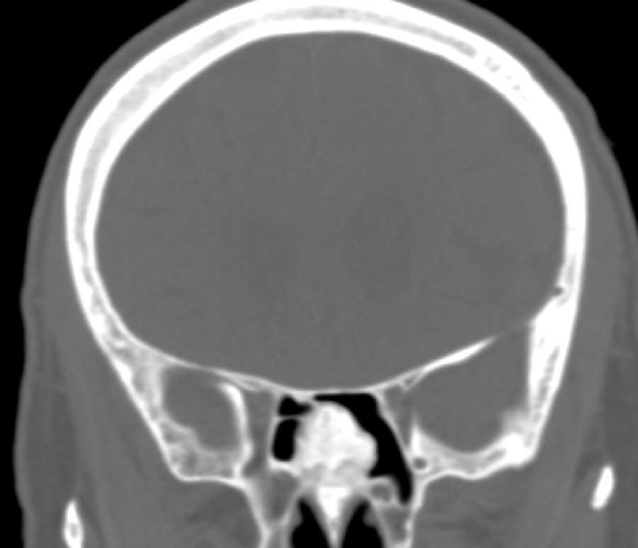 Sinus Osteoma - Neuro MR Case Studies - CTisus CT Scanning