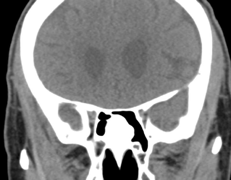 Sinus Osteoma - CTisus CT Scan