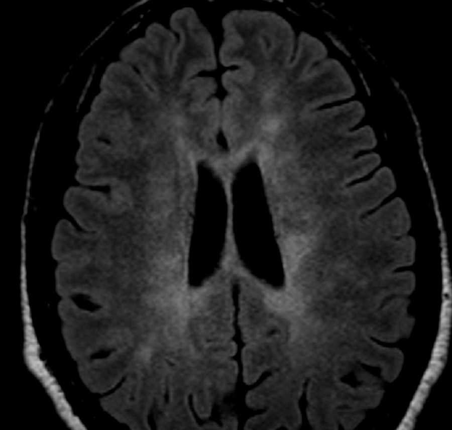 Multiple Sclerosis - CTisus CT Scan