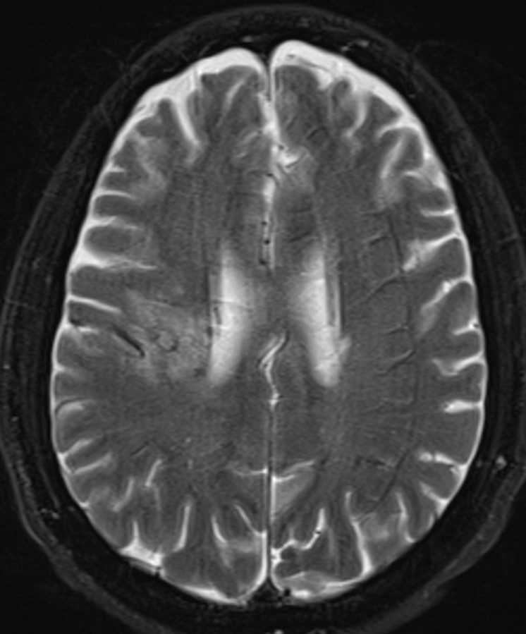 Developmental Venous Anomaly - Neuro MR Case Studies - CTisus CT Scanning