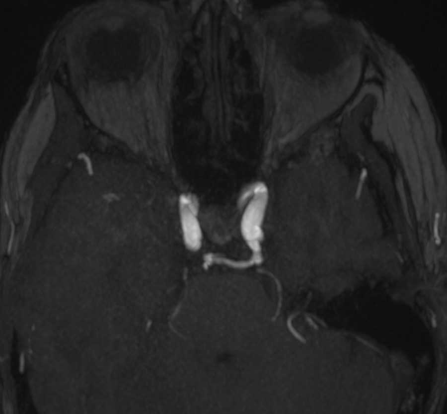 Persistent Trigeminal Artery - CTisus CT Scan