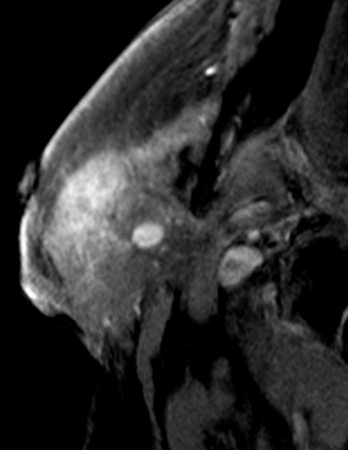 Acute parotiditis - CTisus CT Scan