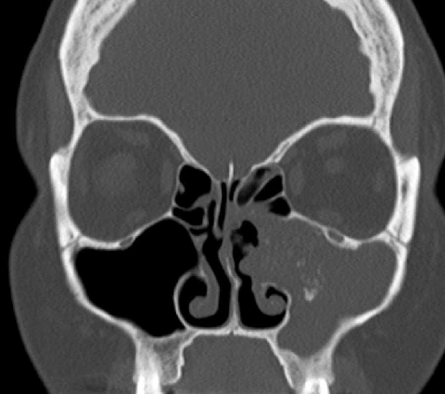 Sinus Mycetoma - CTisus CT Scan