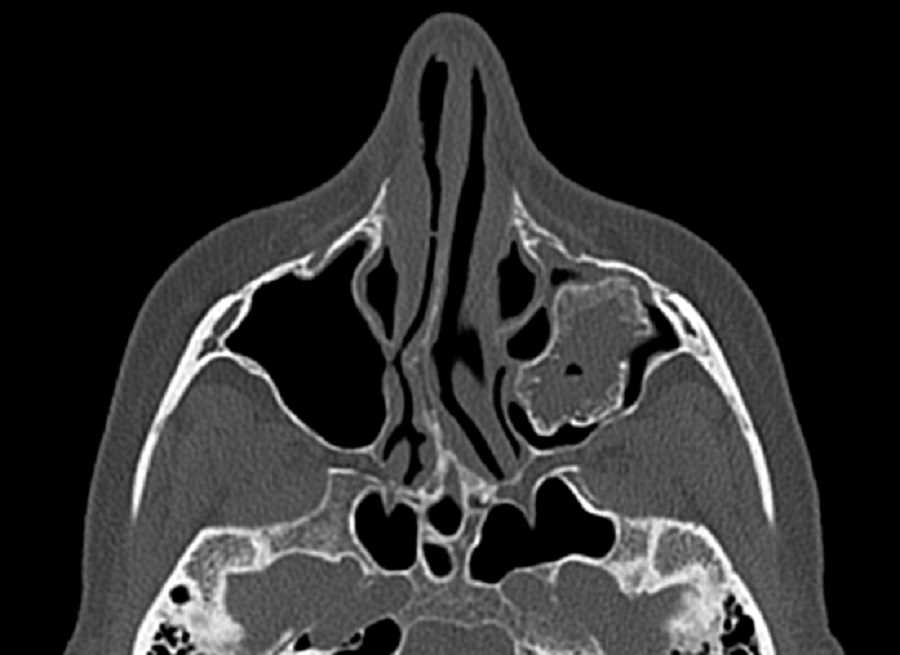 Odontogenic Ossifying Fibroma - CTisus CT Scan