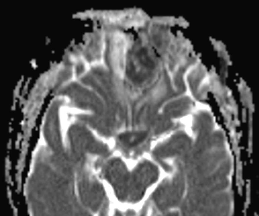 Intracranial Granulomatous Reaction - CTisus CT Scan