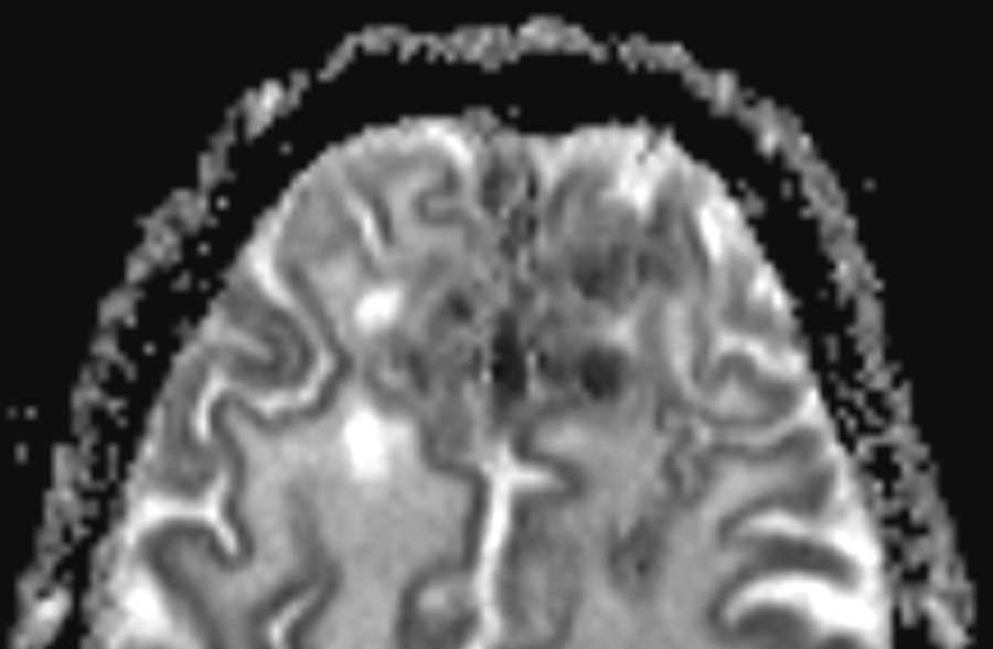 Intracranial Aspergillosis - CTisus CT Scan