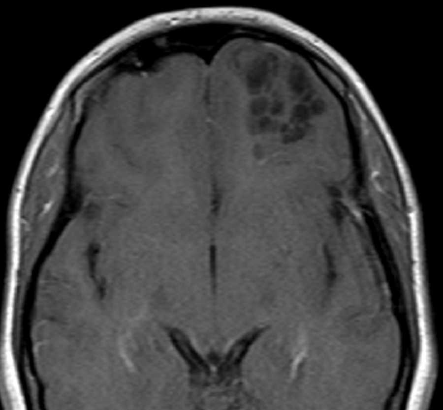 Dysembryoplastic neuroepithelial tumor (DNET) - CTisus CT Scan