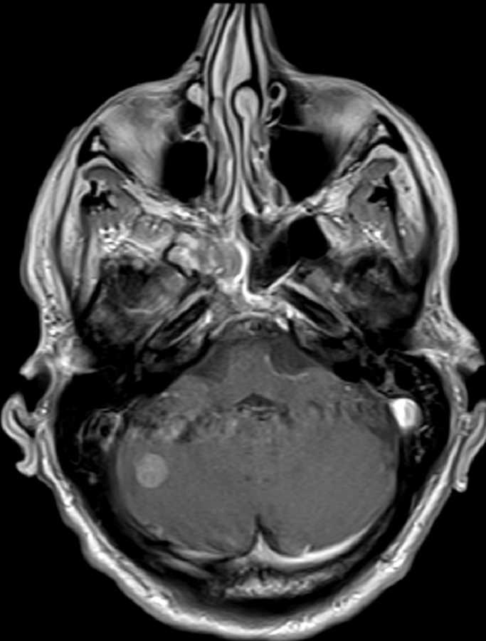 Capillary Telangiectasia - CTisus CT Scan